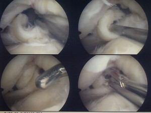 Knee Arthroscopy, Keyhole Surgery