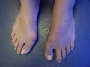 Before and After Bunion Corrective Surgery