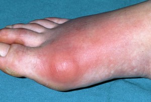 Inflamed Gout Toe