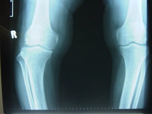 Xray of the Osteoarthritis Knee