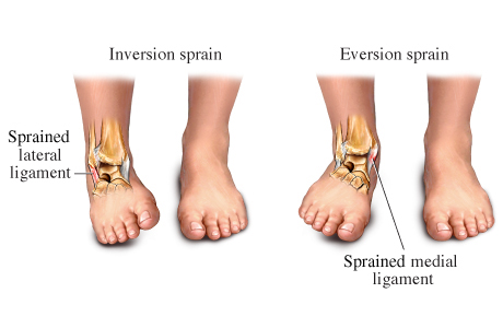 Inversion and Eversion Ankle Sprain