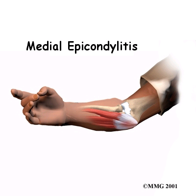 Medial Epicondylitis