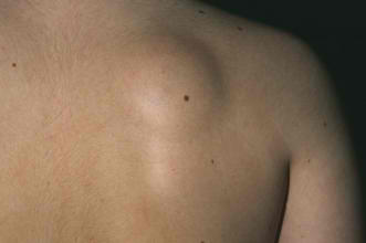 Steroid injections in upper back