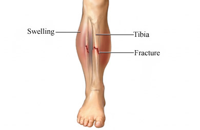 What is the treatment for a fibula fracture?