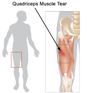 Quadriceps Strain Specialist | Singapore Sports & Orthopaedic Surgeon