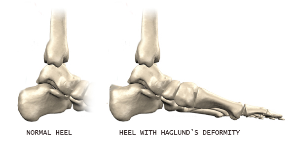 Haglund's Deformity