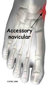 Accessory Navicular Problems