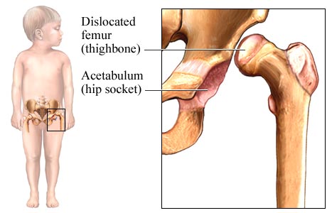 Dislocated Hip