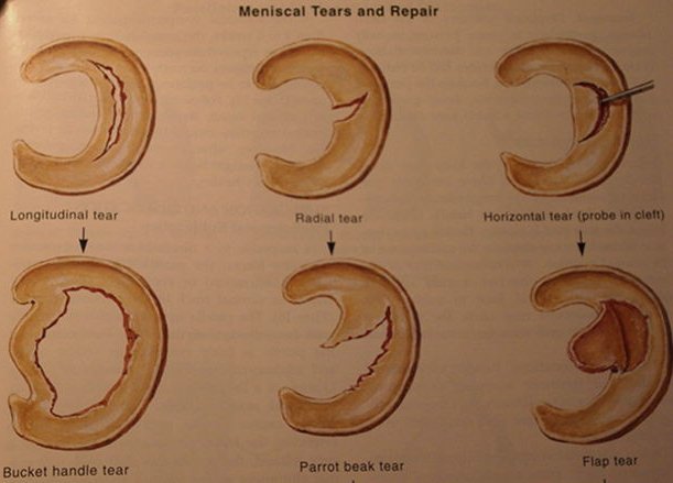 Meniscus Tear Type